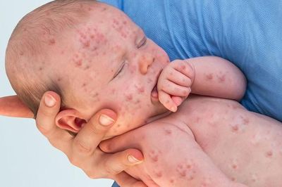 Số ca mắc sởi tăng hơn 30 lần, WHO yêu cầu hành động khẩn cấp