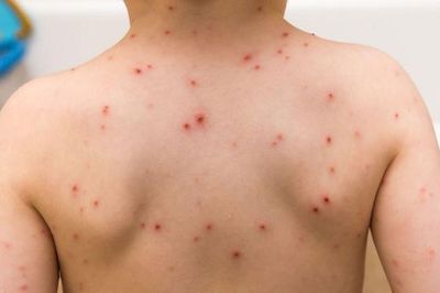 Phòng chống ngăn chặn bệnh sởi bùng phát