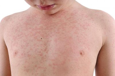 Ca mắc rubella đầu tiên trong năm tại Thủ đô