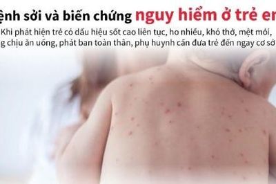 Số ca sốt phát ban nghi sởi tăng 2,7 lần so với cùng kỳ năm 2023