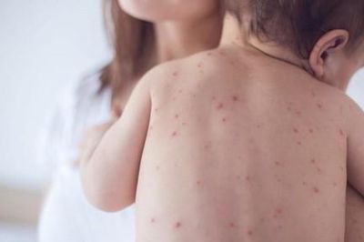 TPHCM ghi nhận 2 trẻ em chưa tiêm vắc xin bị mắc bệnh sởi