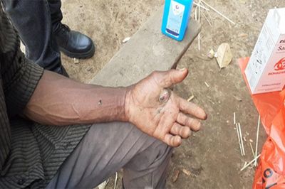 Bệnh than bùng phát ở Uganda, 3 người tử vong
