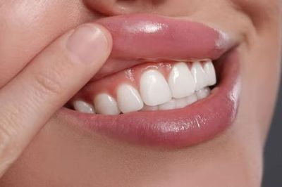 Bỏ quên khe nướu (lợi) - lý do đau răng, viêm nướu (lợi) kéo dài