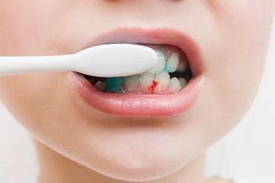 Vì sao bị chảy máu chân răng?