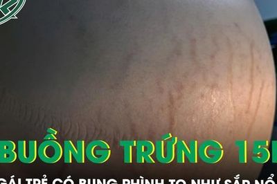 Bụng phình to như sắp nổ cô gái trẻ mang u buồng trứng khổng lồ 15kg