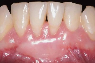 Những điều nên và không nên sau ghép lợi