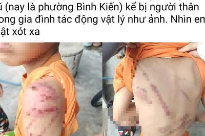 Diễn biến mới vụ bé trai chi chít vết thương ở Đắk Lắk