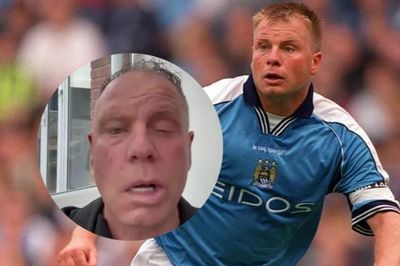 Mặt biến dạng của cựu đội trưởng Man City