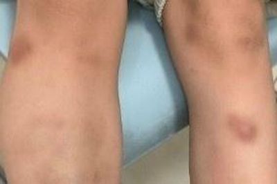 Bé trai nổi đầy bầm tím sau ăn thịt nướng, bác sĩ tìm ra nguyên nhân đáng lo
