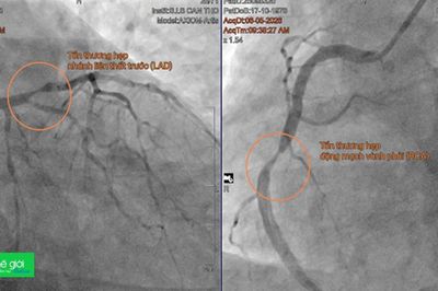Lần đầu đặt stent tự tiêu cứu bệnh nhân nhồi máu cơ tim tại ĐBSCL