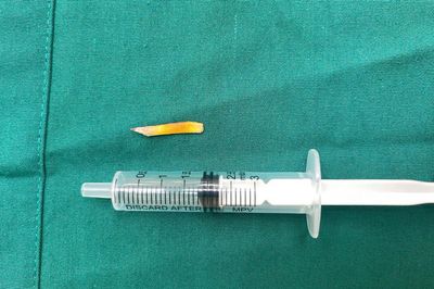Phẫu thuật cứu cụ bà 104 tuổi bị mảnh gỗ 2cm vật đâm thủng ruột non