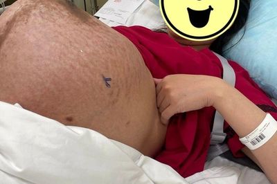 Chiếc bụng mang thai đôi chằng chịt vết rạn, ai nhìn cũng xót xa: 'thở thôi cũng mệt'