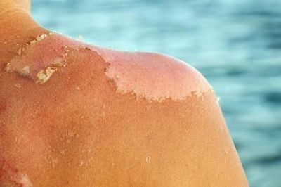 Bỏng nắng phải làm gì để tránh tổn thương da nghiêm trọng?