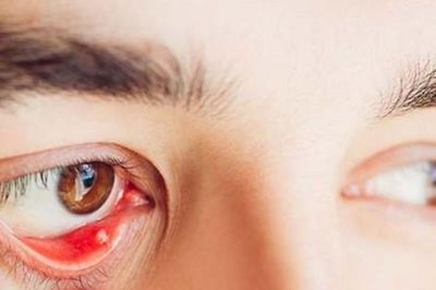 Nguyên nhân gây cộm mắt và cách khắc phục