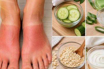5 cách tự nhiên giúp làm dịu, cải thiện tình trạng cháy nắng ở bàn chân