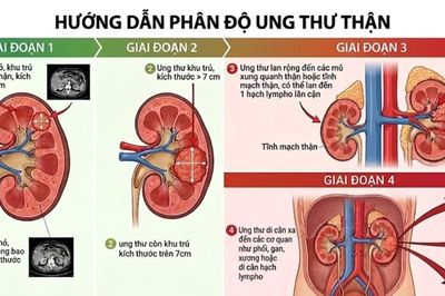 Đau lưng kéo dài, người đàn ông 45 tuổi phát hiện ung thư thận