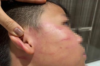 Vụ giáo viên nước ngoài tát học sinh: Gia đình nói bé trai bị thủng màng nhĩ