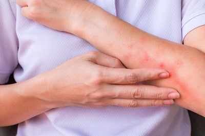 Nắng nóng khiến nguy cơ viêm da gia tăng, phòng ngừa thế nào?