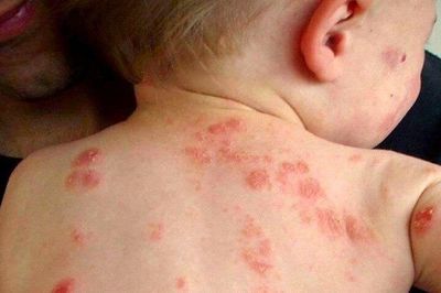 Bệnh chốc mùa hè: Nhận biết sớm để tránh biến chứng