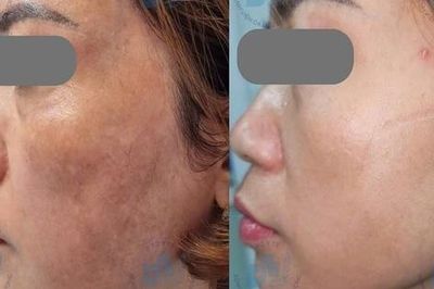 Nám da có nên điều trị bằng laser?