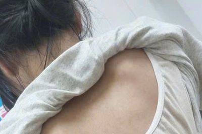 Cột sống thiếu nữ 'uốn lượn' hình chữ S, bác sĩ chỉ ra sai lầm nhiều người mắc
