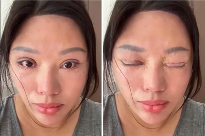 Phẫu thuật mí mắt hỏng, nạn nhân còn bị kiện ngược