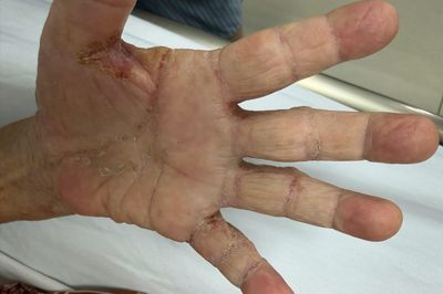 Loài ký sinh trùng tưởng đã 'biến mất' tấn công một gia đình ở Tây Ninh
