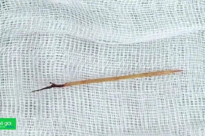 Bé trai nguy kịch, bác sĩ sốc khi phát hiện tăm tre đâm xuyên tim