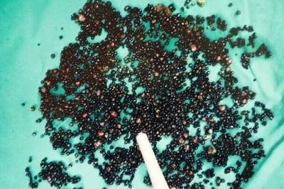 Đau bụng suốt nhiều tháng, người đàn ông 43 tuổi sốc nặng khi bác sĩ gắp ra thứ 'đáng sợ' trong bụng