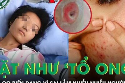 Người phụ nữ chết lặng khi thấy mặt như 'tổ ong', nguy cơ biến dạng vì sai lầm nhiều người mắc