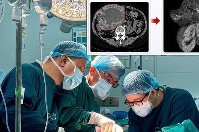 U gan 2 cm 'phình' lên 20 cm do tự điều trị bằng thuốc nam