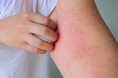Sử dụng thuốc gì khi nổi mề đay, mẩn ngứa?