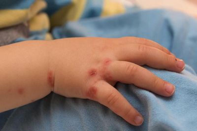 Cứu sống trẻ 23 tháng tuổi nguy kịch vì mắc tay chân miệng