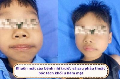 Bóc tách thành công khối u lớn phá hủy xương hàm cho bé trai 7 tuổi