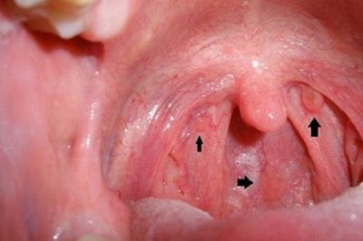 Dấu hiệu nhận biết sớm ung thư vòm họng hiệu quả