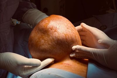 Chịu đựng vòng một nặng 3,5 kg, người phụ nữ phải phẫu thuật gấp