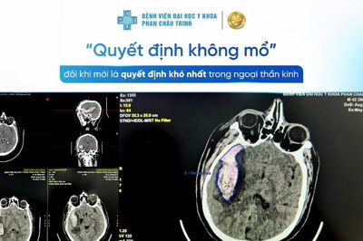Quyết định không mổ đôi khi là quyết định khó nhất trong Ngoại thần kinh