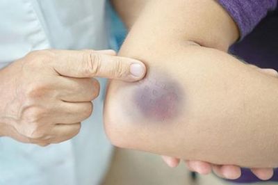 Xuất hiện nhiều vết bầm tím không rõ nguyên nhân cảnh giác với giảm tiểu cầu