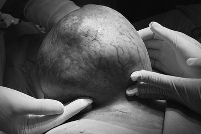 Ngại không đi khám sớm, người bệnh chịu đựng khối u vú nặng gần 4kg