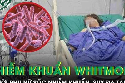 Người phụ nữ 43 tuổi sốc nhiễm khuẩn, suy đa tạng sau 5 ngày sốt