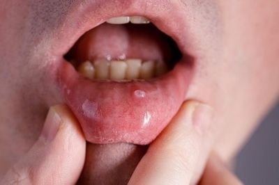 Đi khám vì dấu hiệu lạ, người đàn ông ngỡ ngàng khi biết mắc ung thư