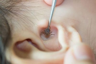 Trong nhà nuôi nhiều thú cưng, bọ chét ký sinh trên màng nhĩ bé gái 2 tuổi
