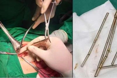 Phẫu thuật lấy 25 viên nam châm trong đường tiêu hóa bệnh nhi