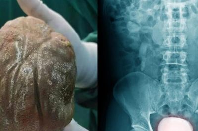 Đau đớn mang 'khối đá' 1,3kg trong cơ thể suốt nhiều năm vì ngại đi khám