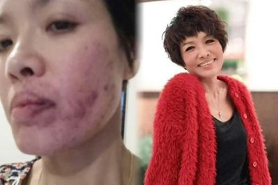 Nữ diễn viên bị tát bầm mặt