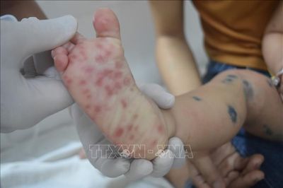 Bệnh tay chân miệng gia tăng mạnh, Cà Mau tăng cường giám sát, phòng chống bệnh