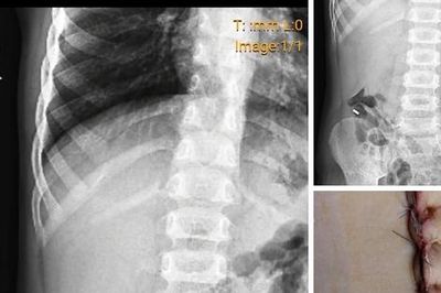 Xôn xao việc bác sĩ phẫu thuật lấy dị vật cho một bệnh nhi ở Nghệ An