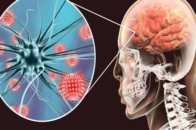 Viêm não tự miễn có nguy cơ tử vong cao nếu chẩn đoán muộn