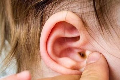 Dấu hiệu nhọt ống tai ngoài ở trẻ và cách xử trí đúng