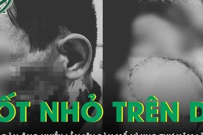 Chủ quan với nốt nhỏ trên da, người đàn ông nhiều lần phẫu thuật ung thư xâm lấn tái phát